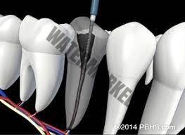 عصبکشی مجدد دندان