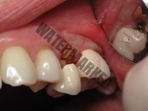 مشکلات روکش دندانی