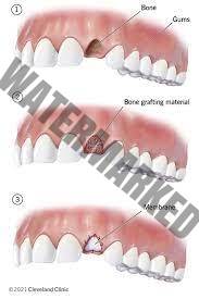 پیوند استخوان قبل از کاشت ایمپلنت دندان