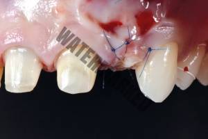 پیوند استخوان قبل از کاشت ایمپلنت دندان