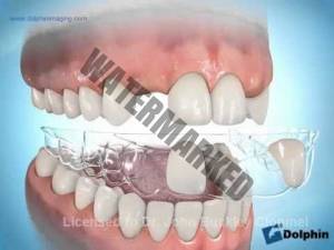 ارتباط ایمپلنت دندانی و درمان ارتودنسی