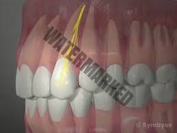 آیا پوسیدگی دندان قابل برگشت است؟