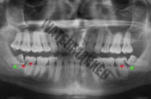  درمان ارتودنسی دندان نهفته