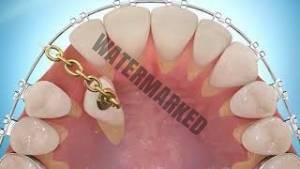 ارتودنسی دندان های نیش