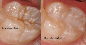 سیلانت دندانی