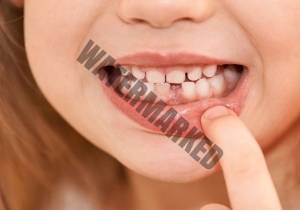 دلایل ایجاد فاصله بین دندان ها