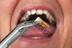 مراقب های بعد از کشیدن دندان