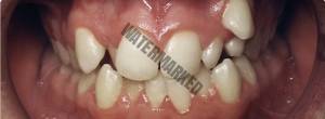 اصلاح دندان نیش با ارتودنسی