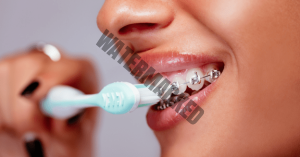 موادی که معمولاً باعث لک شدن بریس های دندانی می شوند
