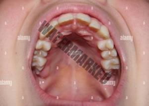 دندان های فک بالا شامل دندان های شیری و دائمی هستند