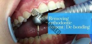 چرا برای بریس ها روی دندان های شما چسب می زنند؟