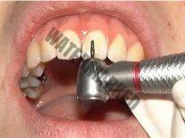 چسب بریس ها چقدر دوام می آورد؟