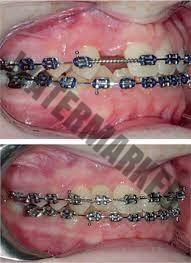 اهمیت اصلاح دندان های از دست رفته برای بایت سالم