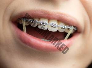 استفاده از رابر بندهای ارتودنسی چه زمانی شروع می شود؟