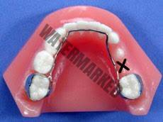 نحوه عملکرد بریس ها برای بستن فاصله ها