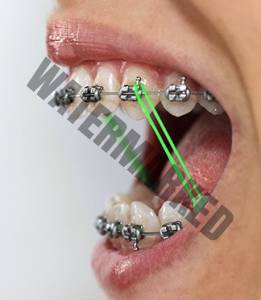 مراحل بریس ها و استفاده از رابر بندها