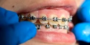 هنگام استفاده از بریس ها از چه چیزهایی باید اجتناب کنید؟